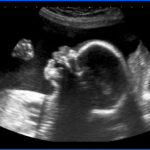 18 weeks pregnancy scan facial profile Merrion Fetal Health