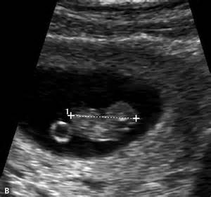 early pregnancy scan