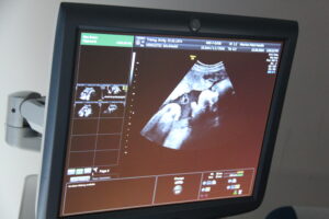 Screen of Pregnancy Scan