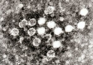Fifth disease parovirus B19